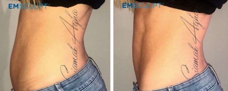 Emsculpt Before & After
