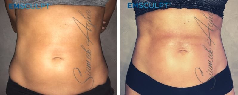 Emsculpt Before & After