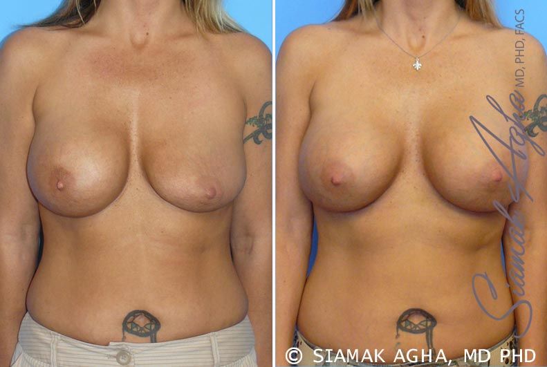 Breast Augmentation Revision Before & After