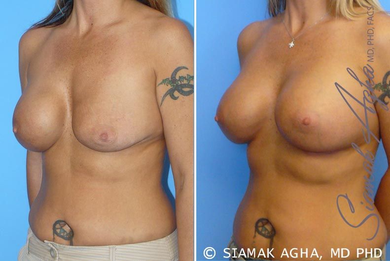 Breast Augmentation Revision Before & After
