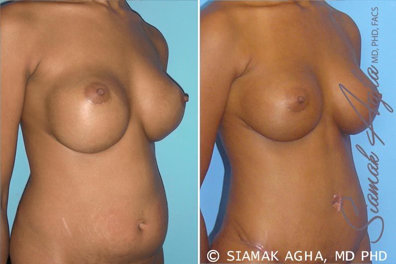Breast Augmentation Revision Before & After