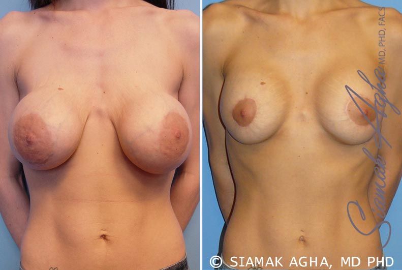 Breast Augmentation Revision Before & After