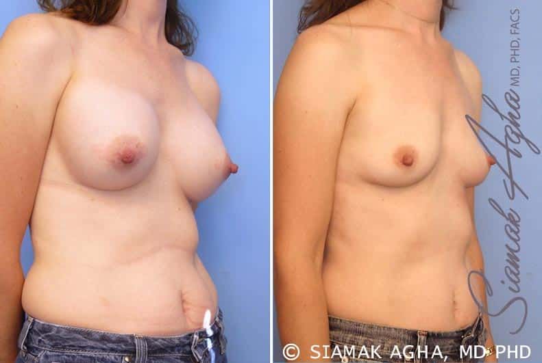 Breast Augmentation Revision Before & After