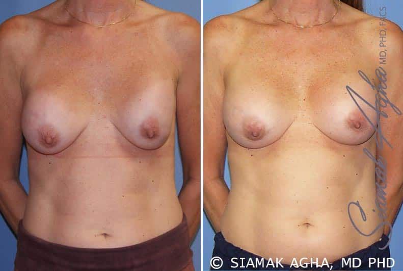 Breast Augmentation Revision Before & After