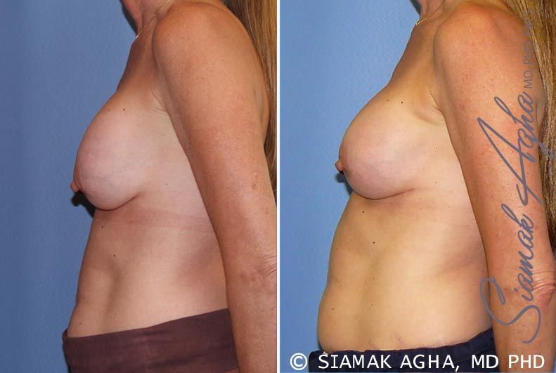 Breast Augmentation Revision Before & After