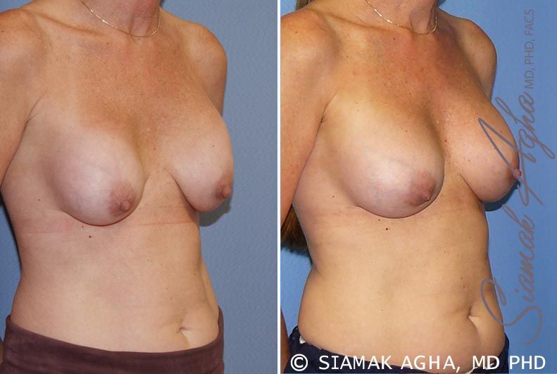 Breast Augmentation Revision Before & After