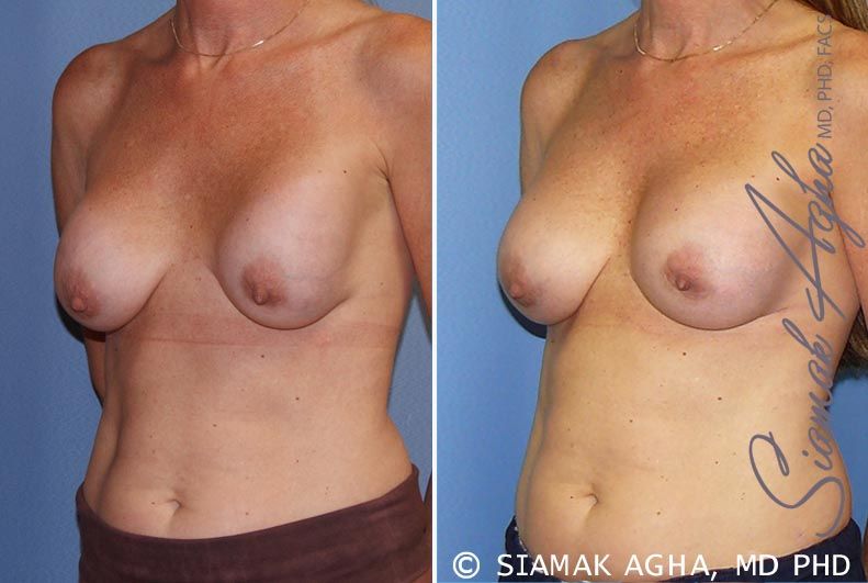 Breast Augmentation Revision Before & After