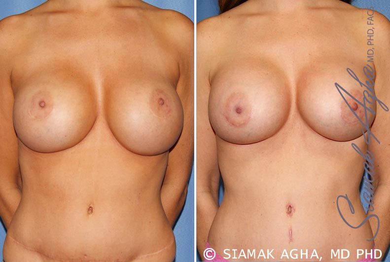 Breast Augmentation Revision Before & After