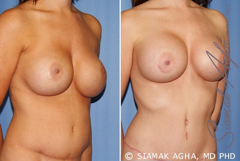 Breast Augmentation Revision Before & After