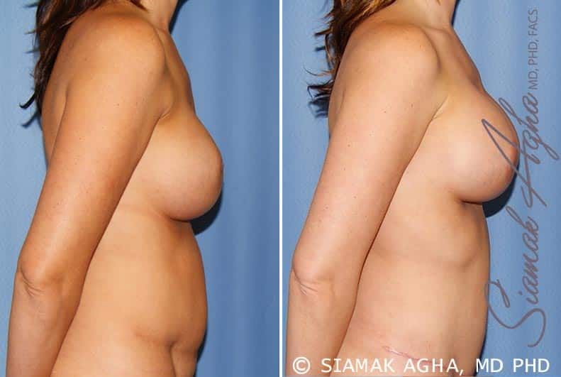 Breast Augmentation Revision Before & After