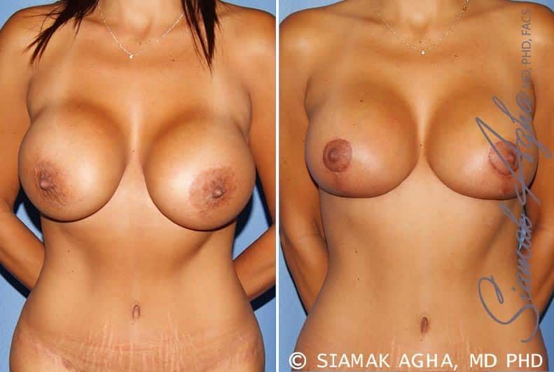 Breast Augmentation Revision Before & After