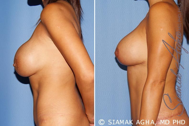 Breast Augmentation Revision Before & After