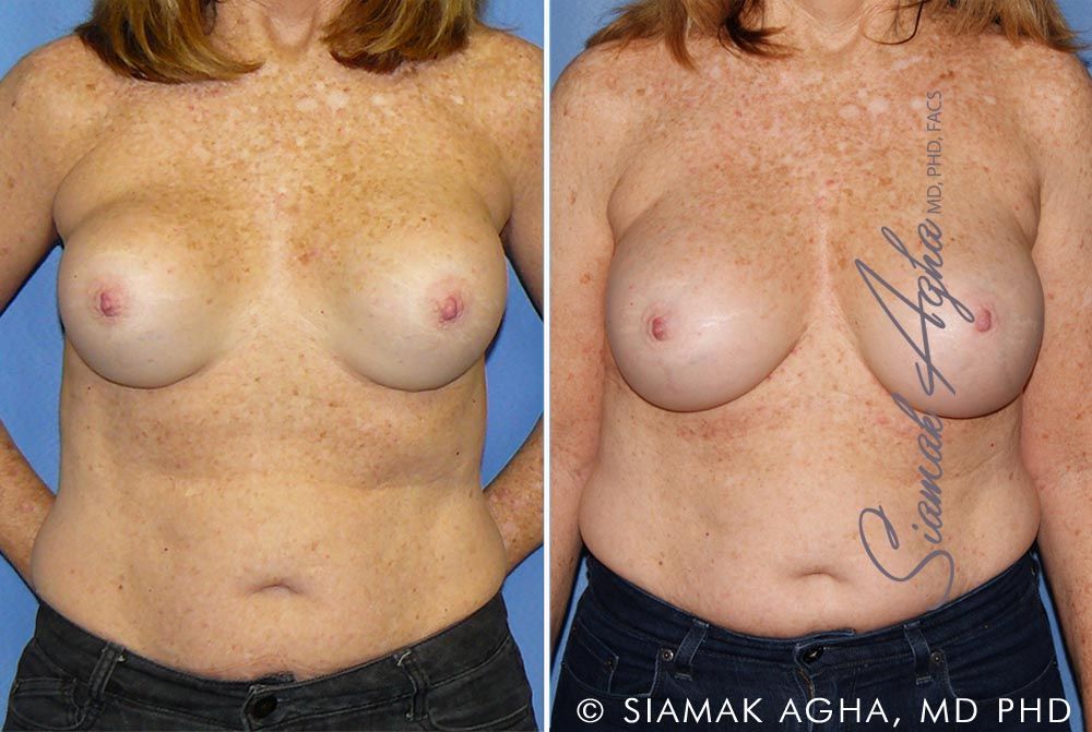 Breast Augmentation Revision Before & After