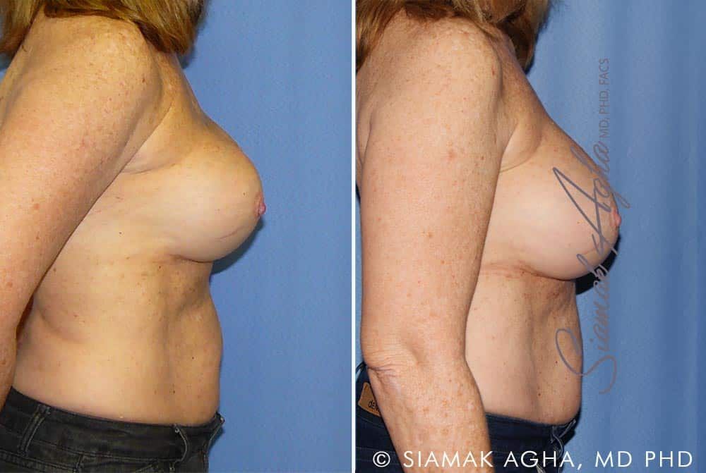 Breast Augmentation Revision Before & After