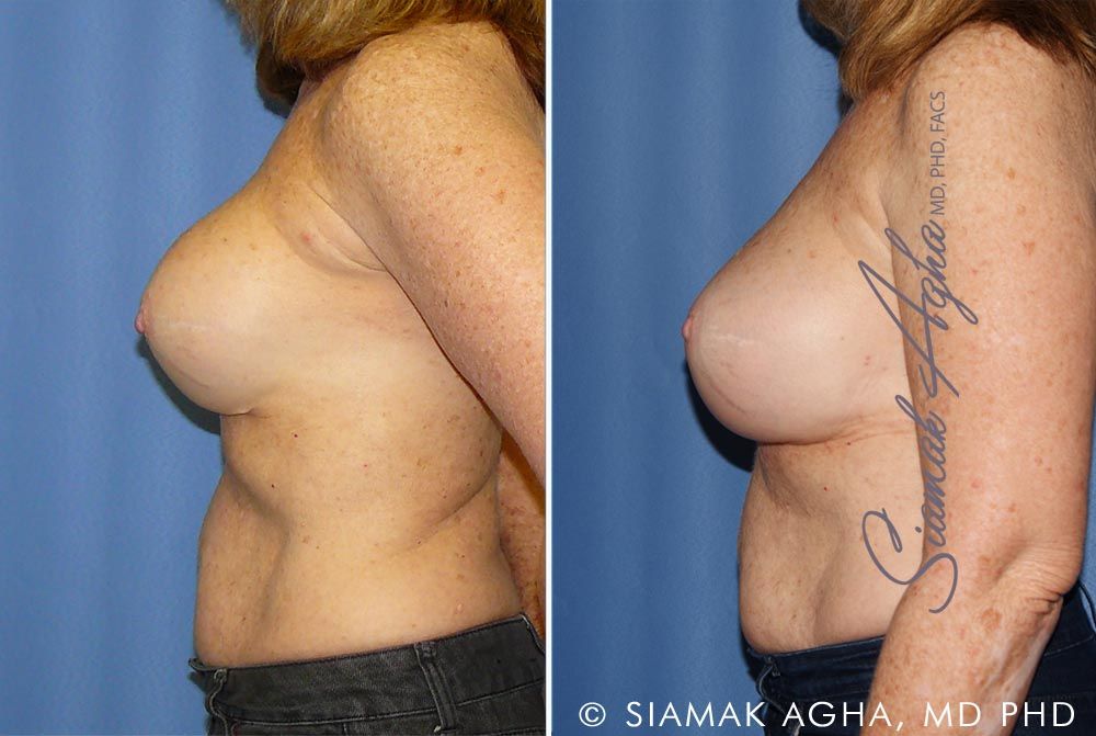 Breast Augmentation Revision Before & After