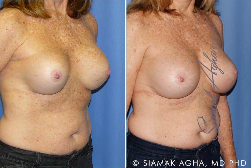 Breast Augmentation Revision Before & After
