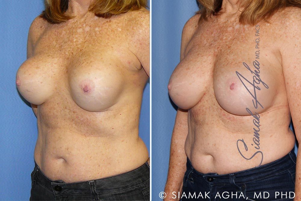 Breast Augmentation Revision Before & After