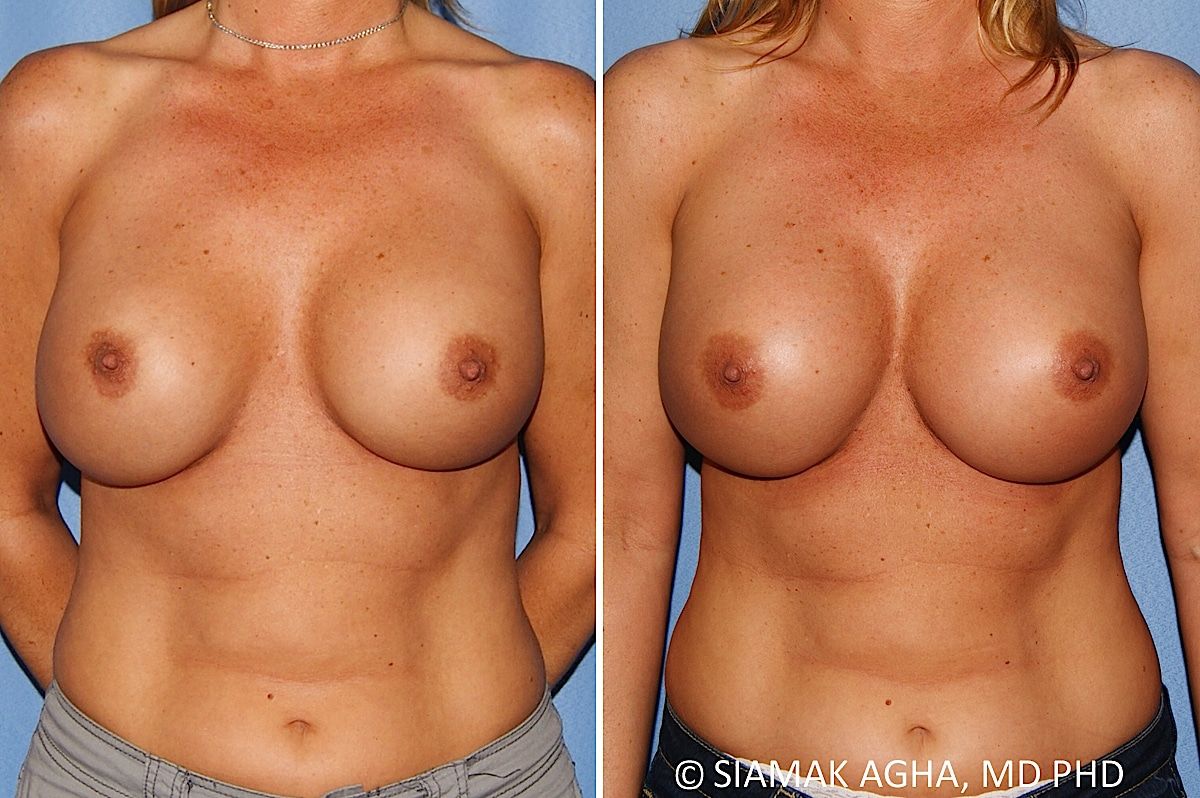 Breast Augmentation Revision Before & After