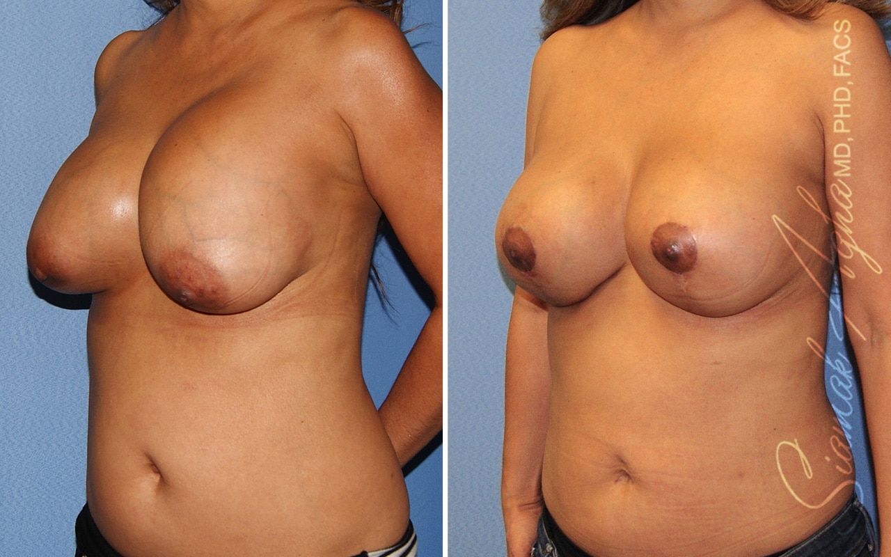 Breast Augmentation Revision Before & After