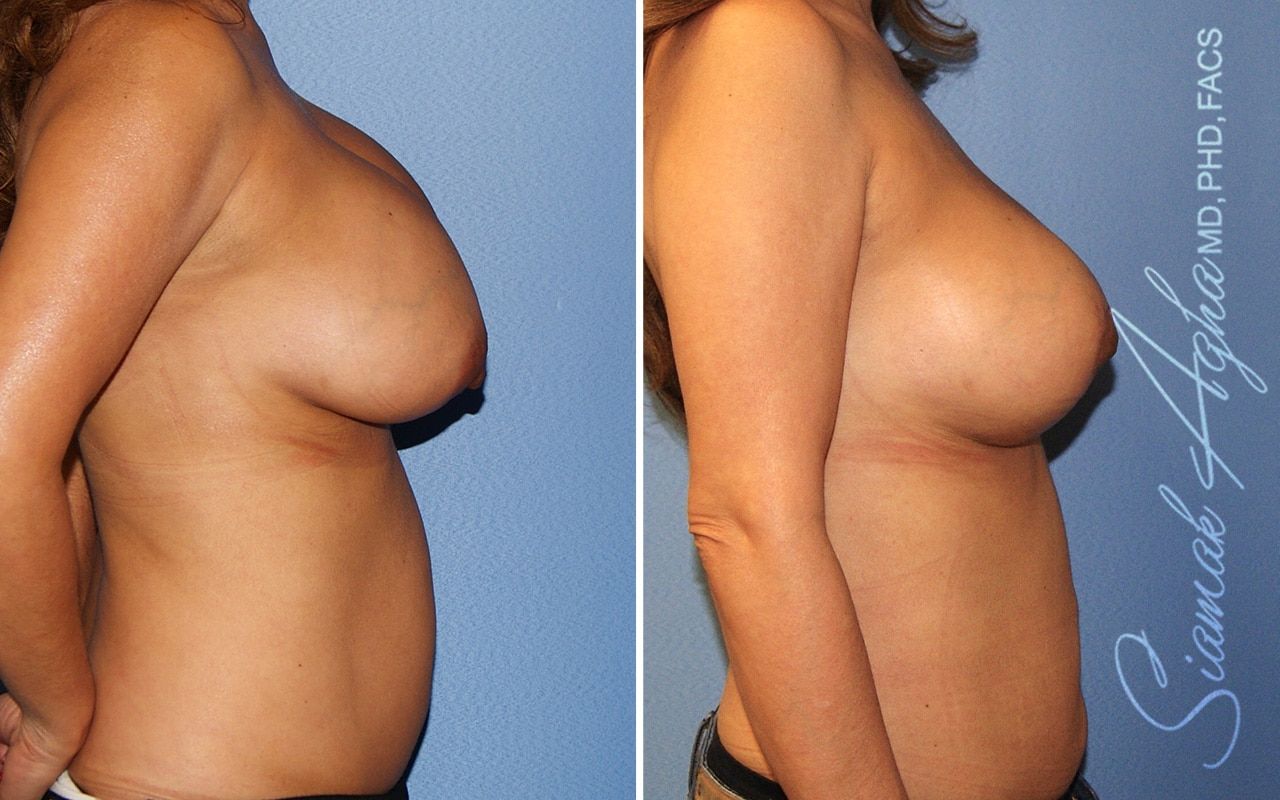 Breast Augmentation Revision Before & After