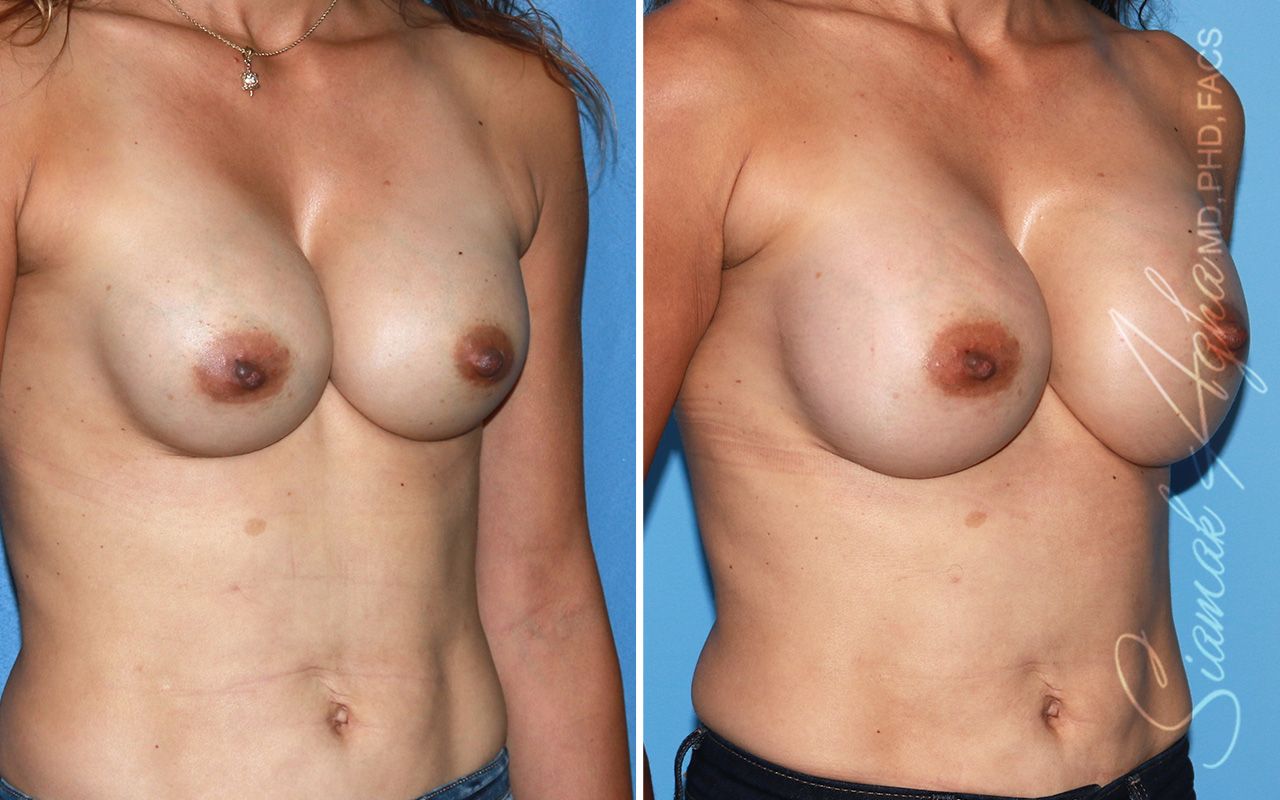Breast Augmentation Revision Before & After