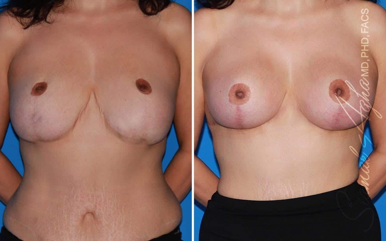 Breast Augmentation Revision Before & After