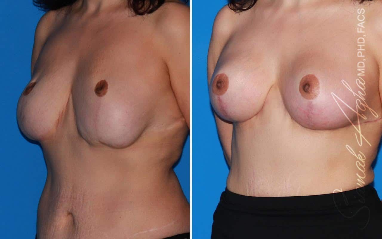 Breast Augmentation Revision Before & After