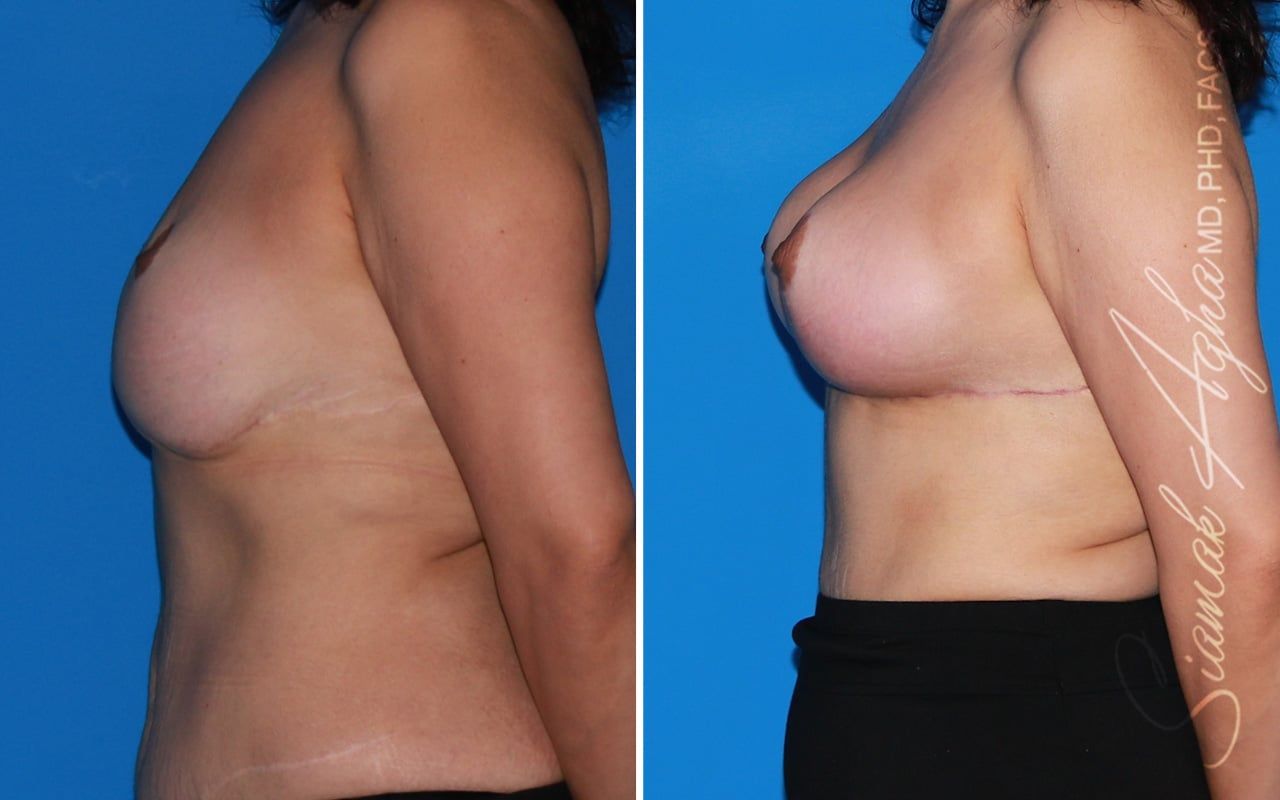Breast Augmentation Revision Before & After