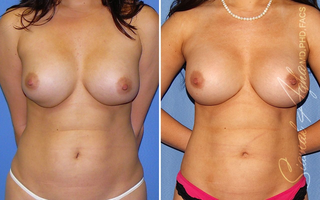 Breast Augmentation Revision Before & After