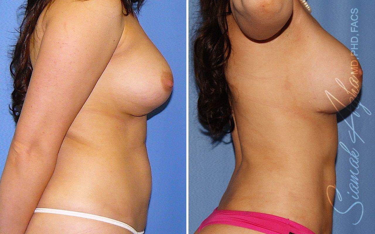 Breast Augmentation Revision Before & After