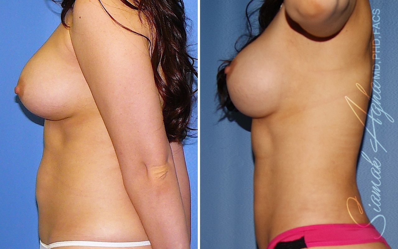 Breast Augmentation Revision Before & After