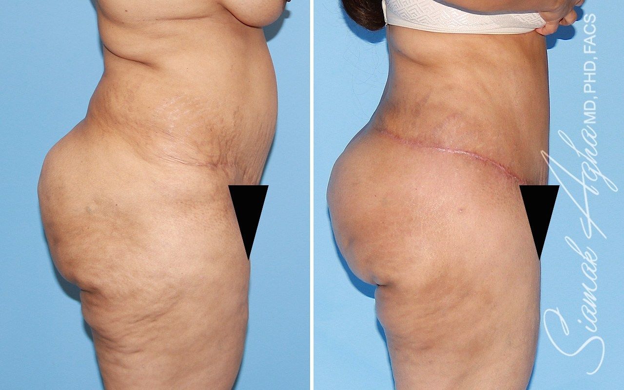 Tummy Tuck With Thigh Lift Before & After