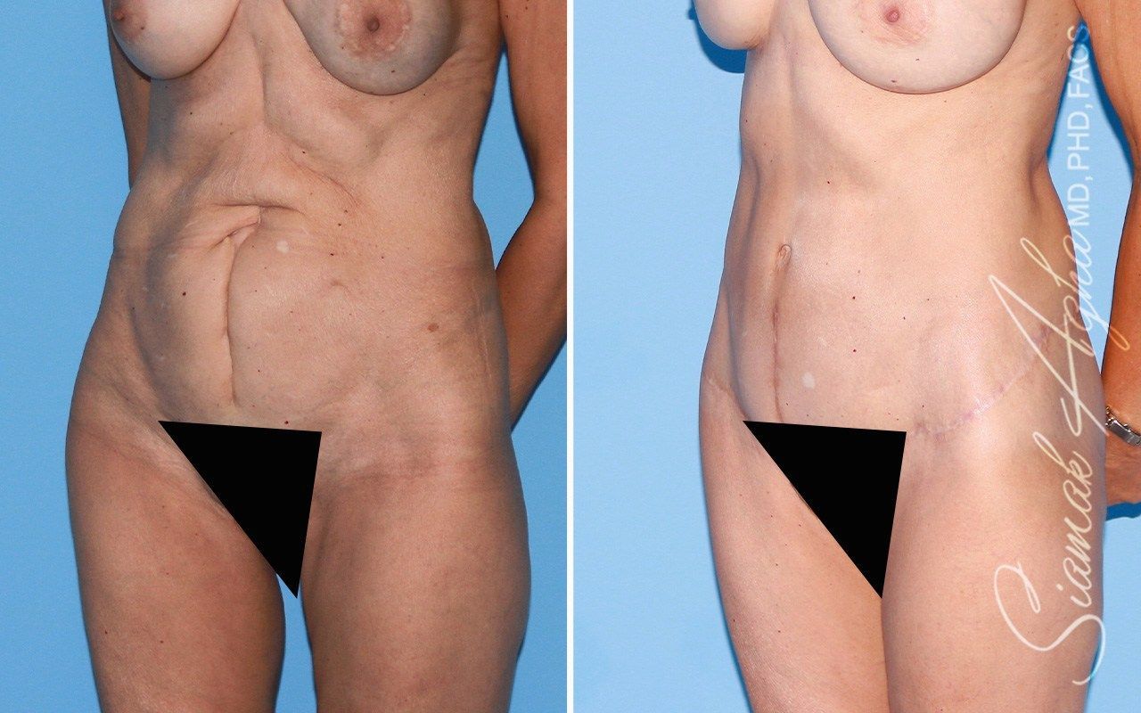 Tummy Tuck With Thigh Lift Before & After