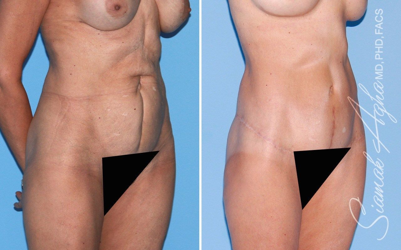 Tummy Tuck With Thigh Lift Before & After