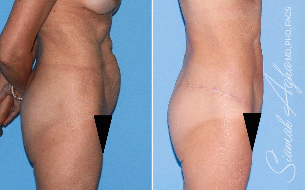 Tummy Tuck With Thigh Lift Before & After