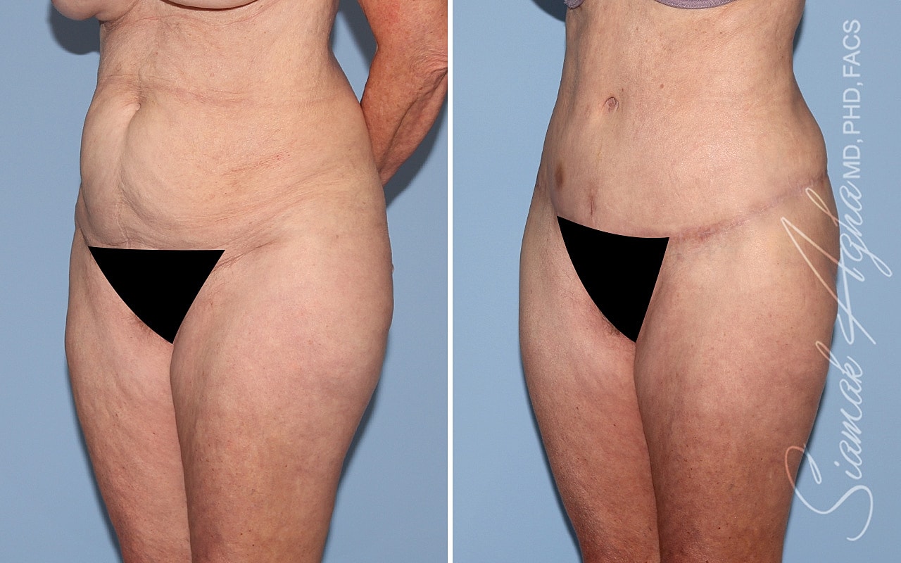 Tummy Tuck With Thigh Lift Before & After