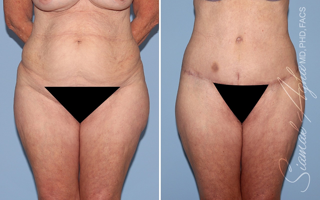 Tummy Tuck With Thigh Lift Before & After