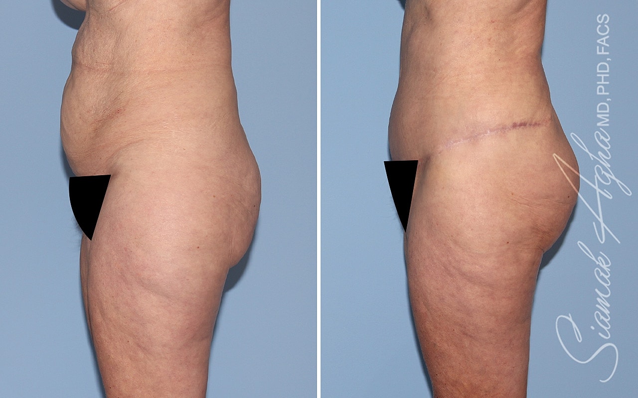 Tummy Tuck With Thigh Lift Before & After