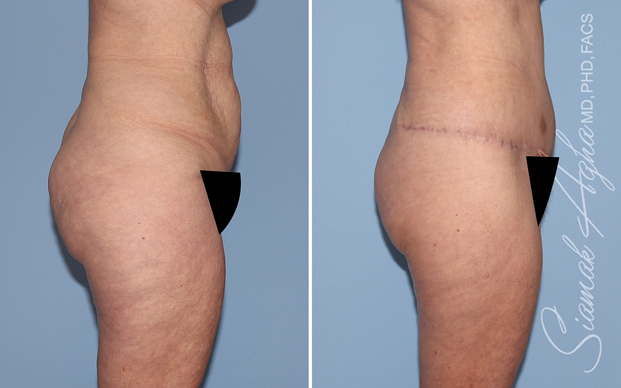 Tummy Tuck With Thigh Lift Before & After