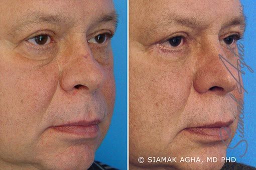 Blepharoplasty Before & After