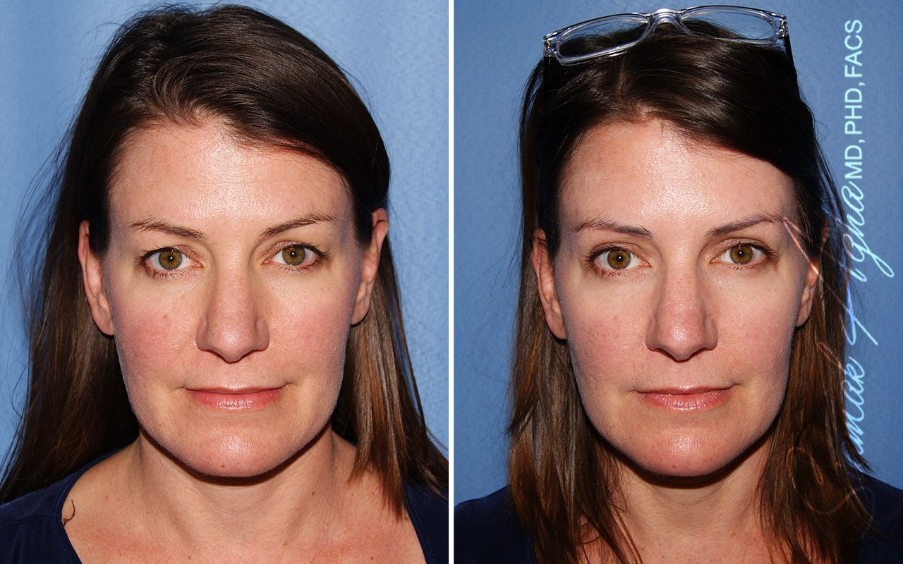 Blepharoplasty Before & After