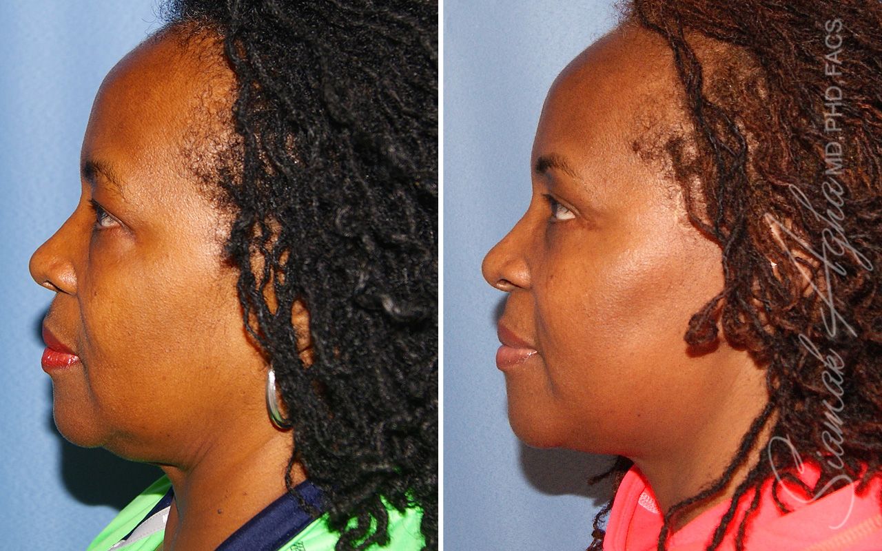 Blepharoplasty Before & After