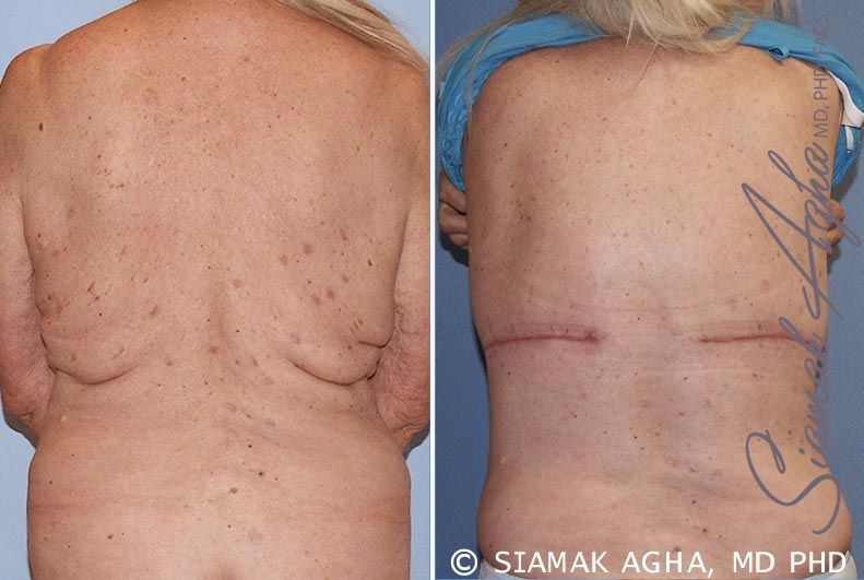 Upper Body Lift Before & After