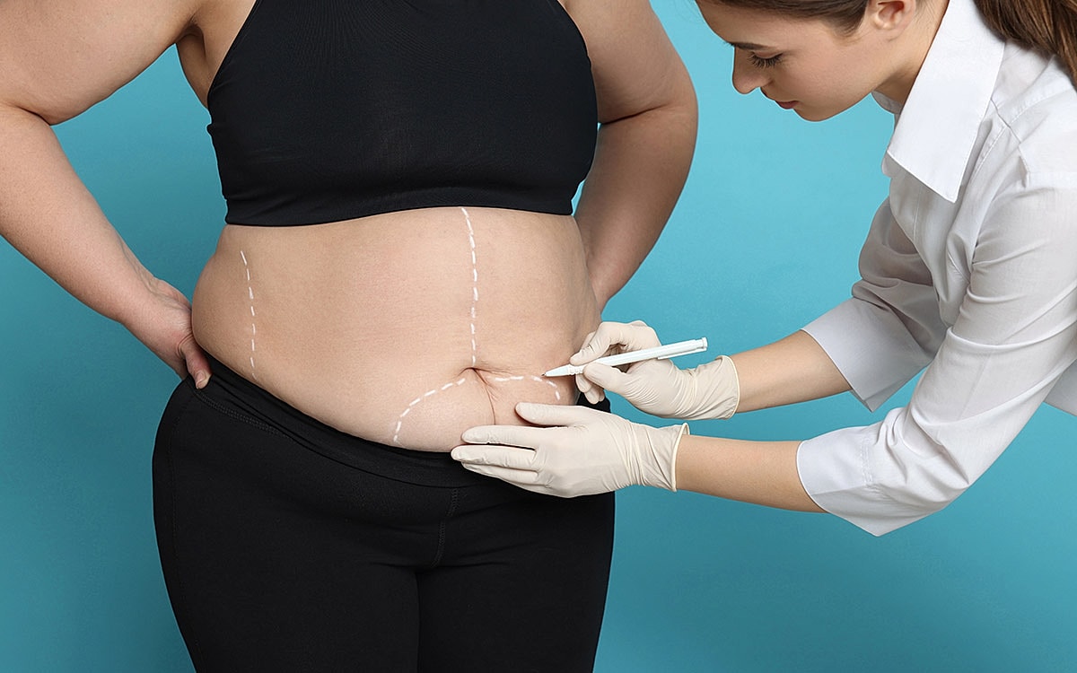 Consultation for abdominal cosmetic surgery preparation.