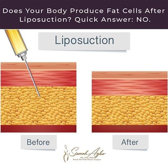Does your body produce fat cells after liposuction?