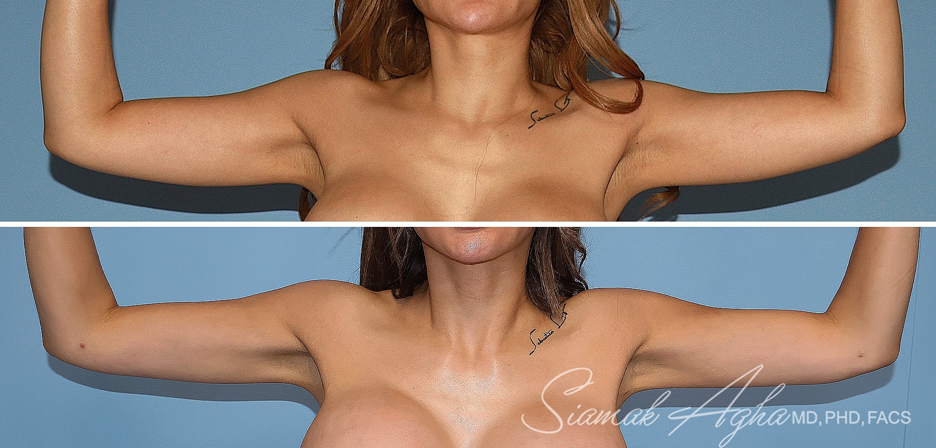 Before and after arm liposuction patient front view