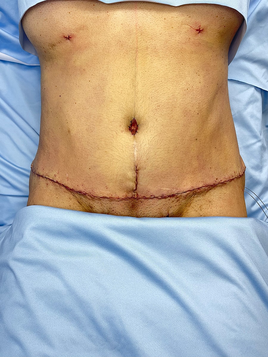 Post-surgery abdomen with visible stitches and scars.