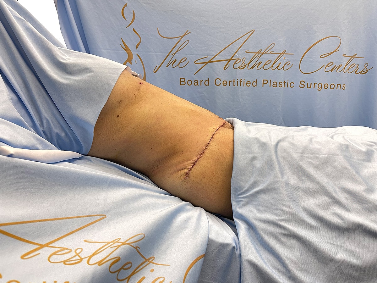 Surgical site on a patient's arm with stitches.