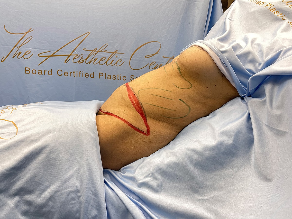 Marked skin in preparation for a cosmetic procedure.