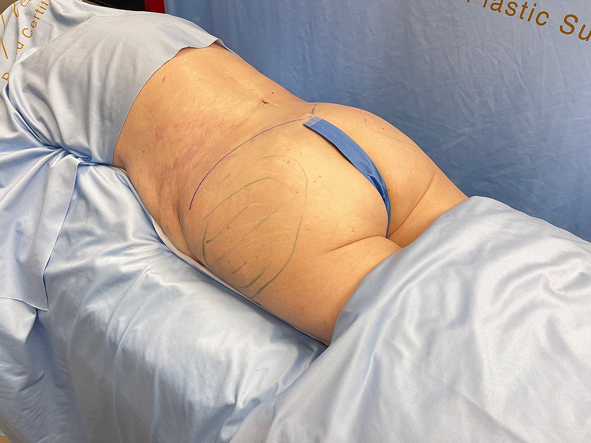 Patient preparing for body contouring procedure.